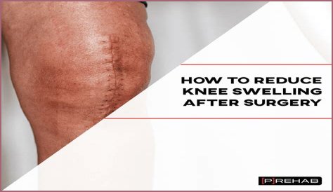 Kevin Nash Shows Off Body Transformation After Knee Replacement